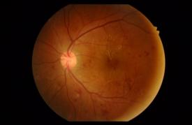 糖尿病による眼底変化 糖尿病による眼底変化