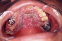 口腔カンジダ症